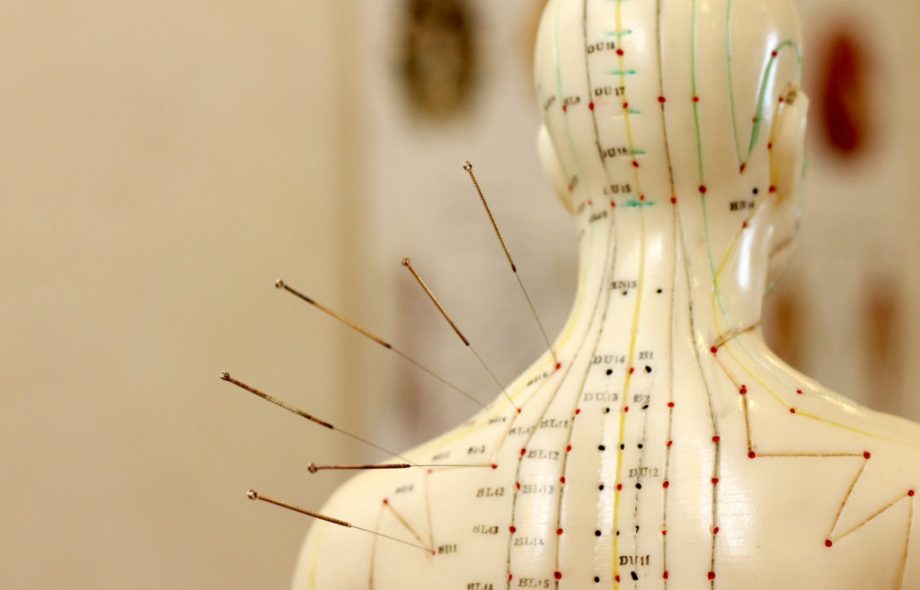 acupuncture