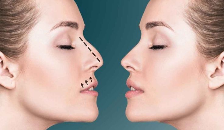 RHINOPLASTY SURGERY Dubai