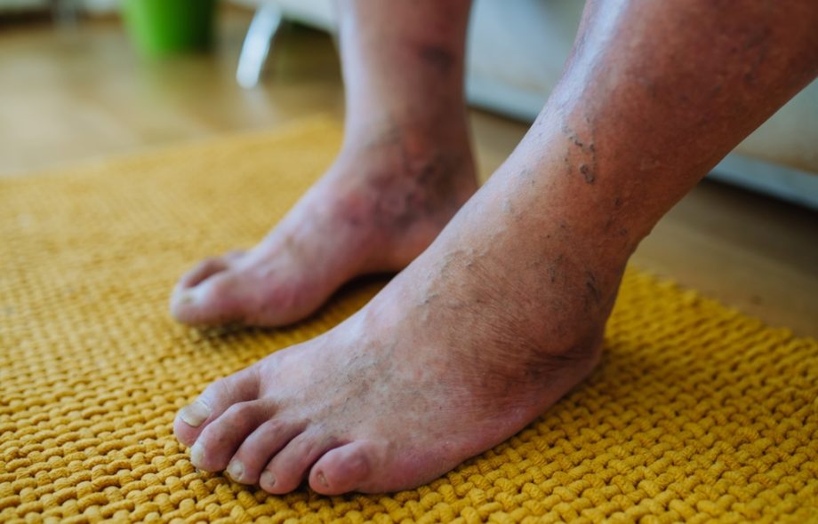 diabetic foot clinical studies near Alexandria