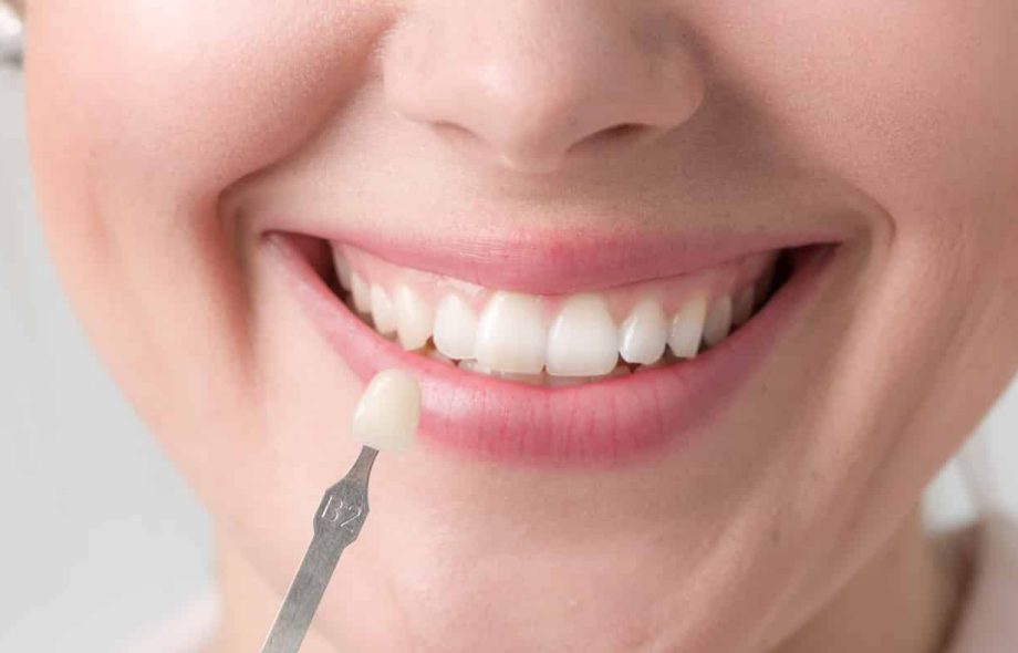 veneer dentistry cost